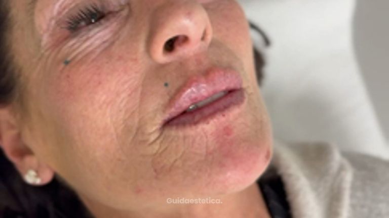 Dott.ssa Sara Carinci Risultato Filler labbra