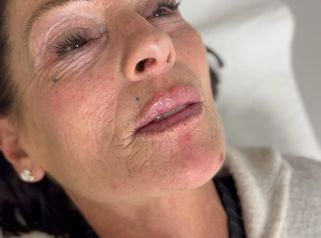 Dott.ssa Sara Carinci Risultato Filler labbra