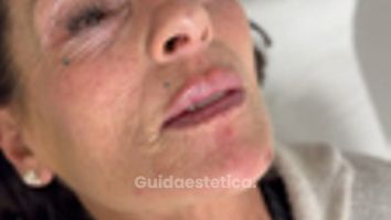 Dott.ssa Sara Carinci Risultato Filler labbra