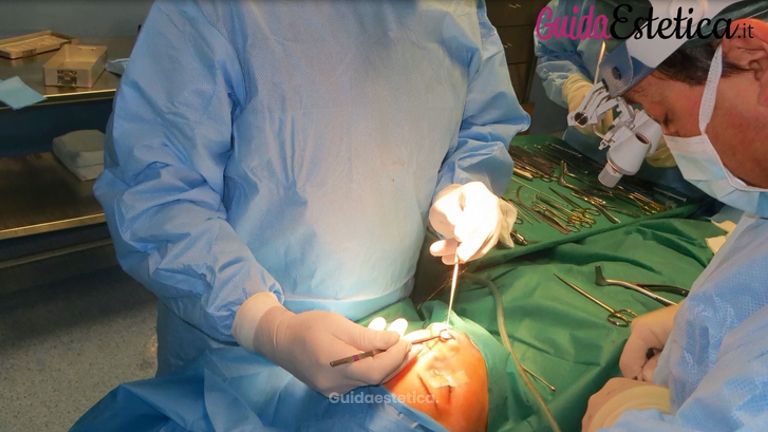 Nuove tecniche per la rinosettoplastica