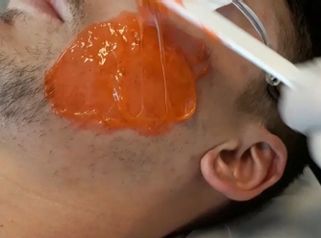 Terapia biofotonica per acne