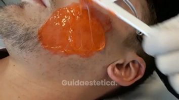 Terapia biofotonica per acne