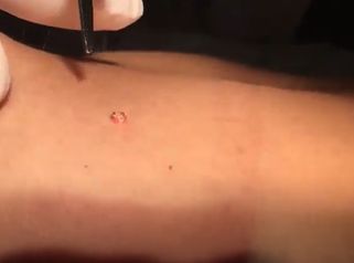 Rimozione cisti e nevi (nei) con il laser 1/3 - Dott. Marcello Melandri