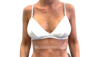 Mastoplastica additiva - Dott. Francesco De Vita