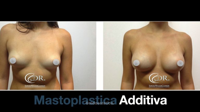Dott. Curreri: Pre e post mastoplastica additiva