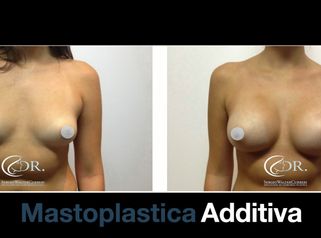 Dott. Curreri: Pre e post mastoplastica additiva