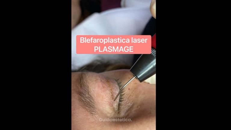 Blefaroplastica - Dr. Luca Zattoni