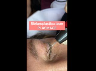 Blefaroplastica - Dr. Luca Zattoni