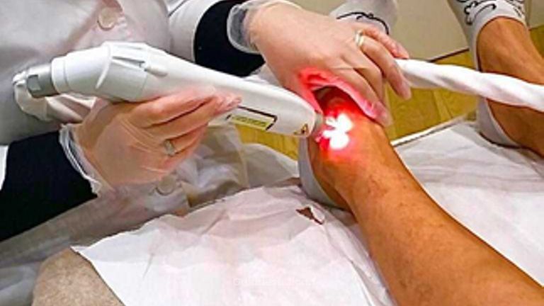 Laser vascolare per la rimozione di vasi capillari e vene Dottoressa Cornelia Florea