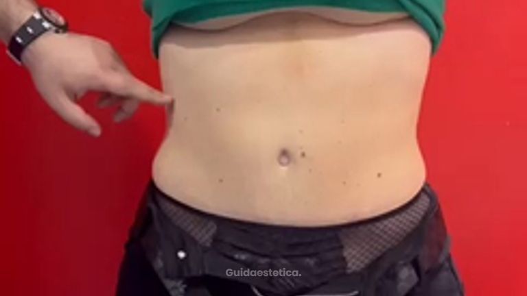 Liposuzione e Addominoplastica