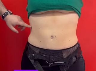Liposuzione e Addominoplastica