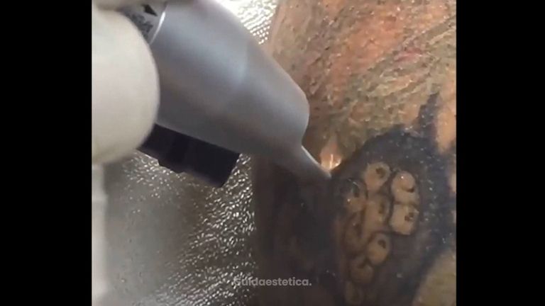 Rimozione tatuaggi