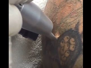 Rimozione tatuaggi