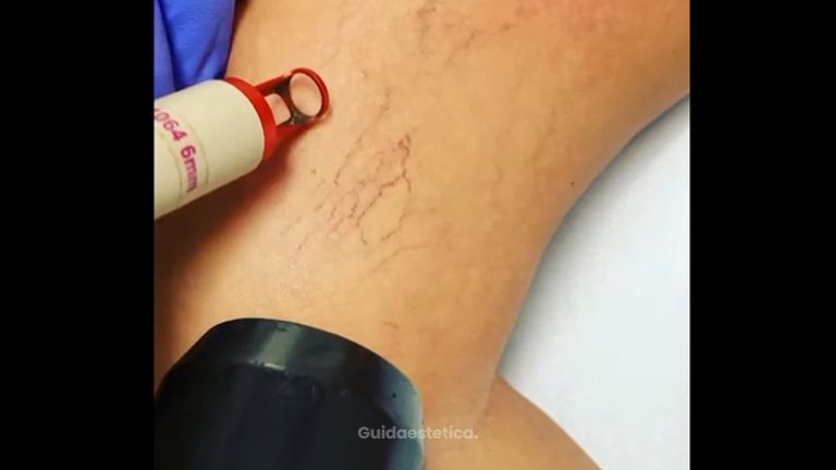 Laser nd-yag Alma Laser specifico x rimozione capillari gambe