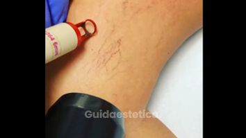 Laser nd-yag Alma Laser specifico x rimozione capillari gambe