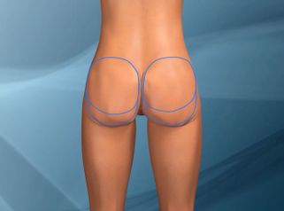 Gluteoplastica