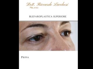 Blefaroplastica - Dott. Riccardo Lucchesi