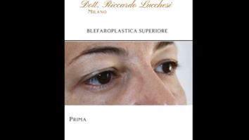 Blefaroplastica - Dott. Riccardo Lucchesi