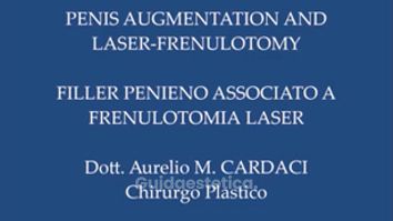 Aumento pene e frenulotomia laser - Dott. Aurelio M. Cardaci