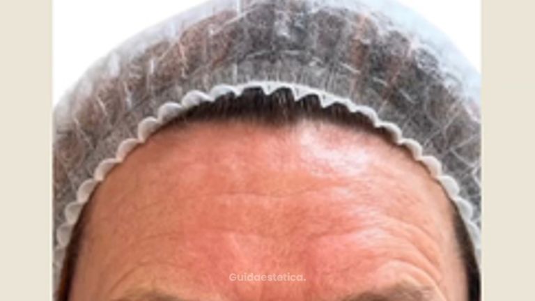 Dott. Giovanni Migliorini neuromiomodulazione con Azzalure