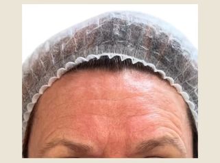 Dott. Giovanni Migliorini neuromiomodulazione con Azzalure