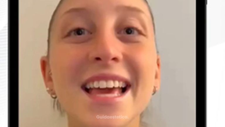 Dottor Gianluca Campiglio Rinosettoplastica: Denise racconta la sua esperienza dopo l’intervento