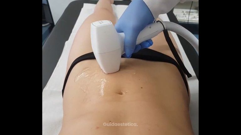 Epilazione Laser Diodo