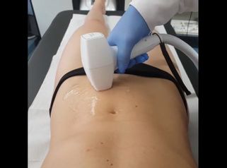 Epilazione Laser Diodo