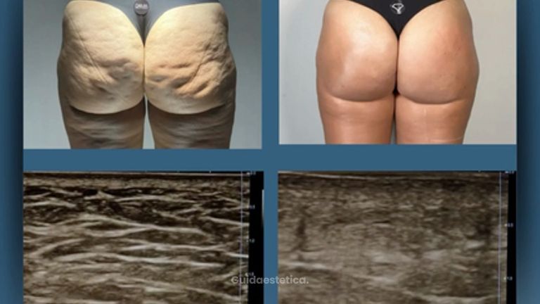 Dott. Dario Martusciello Diamond Incision
