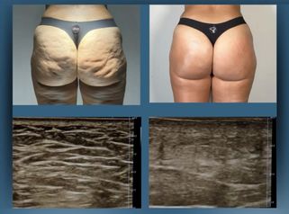 Dott. Dario Martusciello Diamond Incision