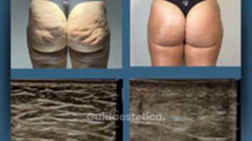 Dott. Dario Martusciello Diamond Incision