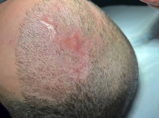 Prof. Dott. Massimiliano Giuliano Trattamento PRP per curare necrosi di II grado.