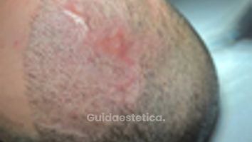 Prof. Dott. Massimiliano Giuliano Trattamento PRP per curare necrosi di II grado.