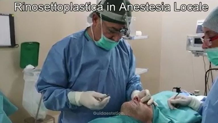 Rinosettoplastica in Anestesia Locale Indolore e Senza Tamponi - Prof. Carlo Grassi