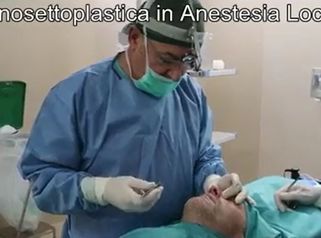 Rinosettoplastica in Anestesia Locale Indolore e Senza Tamponi - Prof. Carlo Grassi