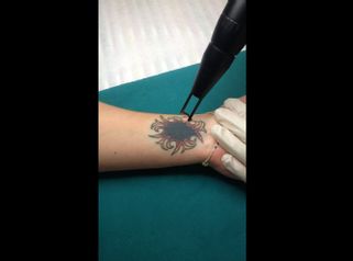 Medicina Estetica Cotilli: Rimozione tatuaggi