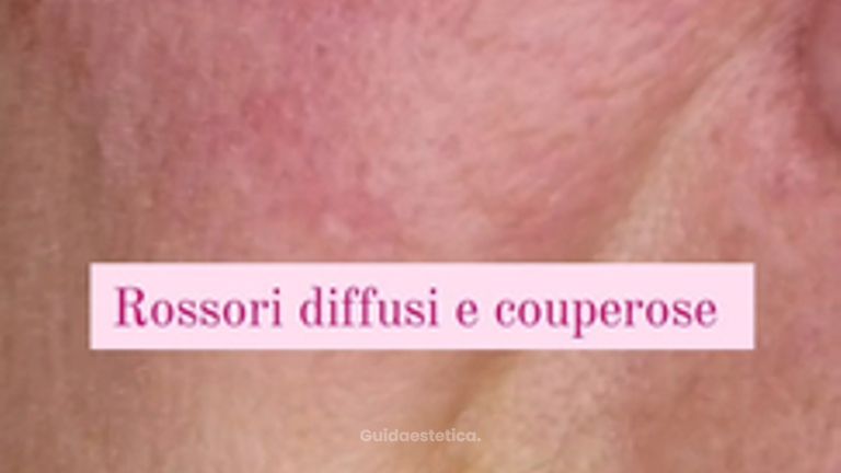 Dott.ssa Irene Pistis  Couperose