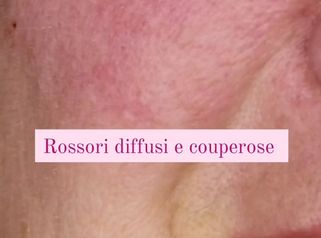 Dott.ssa Irene Pistis  Couperose