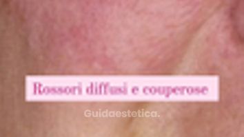Dott.ssa Irene Pistis  Couperose