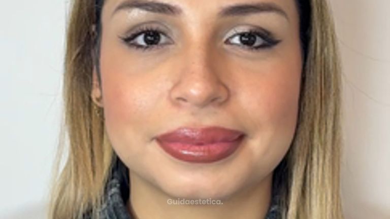 Dott.ssa Sara Carinci Dopo il Botox, che ne pensate?