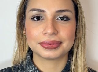 Dott.ssa Sara Carinci Dopo il Botox, che ne pensate?