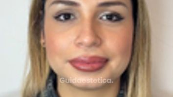 Dott.ssa Sara Carinci Dopo il Botox, che ne pensate?