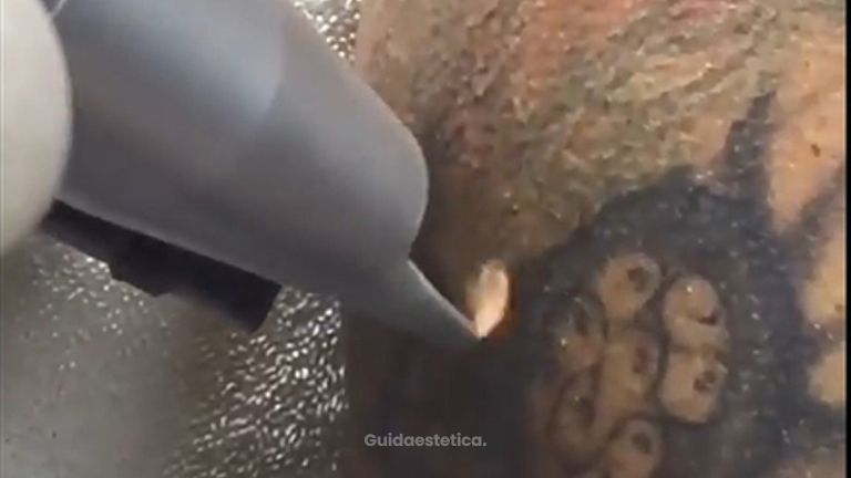 Dott. Luigi Petti: Rimozione tatuaggi