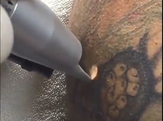 Dott. Luigi Petti: Rimozione tatuaggi