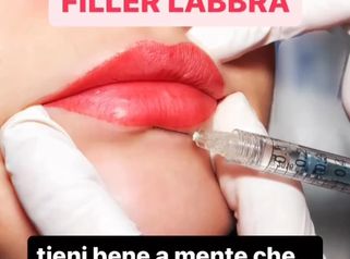 Filler labbra - Dr Antonio Tambuscio