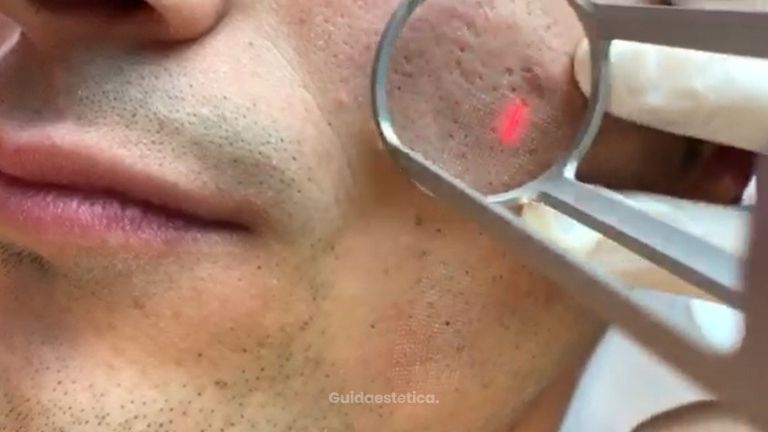 Hs Care: laser C02 acne