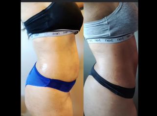 Criolipolisi - Skin Laser Clinic