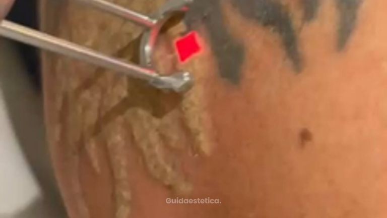 Dott.ssa Cornelia Florea Come rimuovere un tatuaggio nero