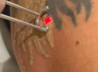 Dott.ssa Cornelia Florea Come rimuovere un tatuaggio nero