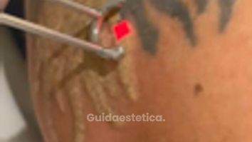 Dott.ssa Cornelia Florea Come rimuovere un tatuaggio nero